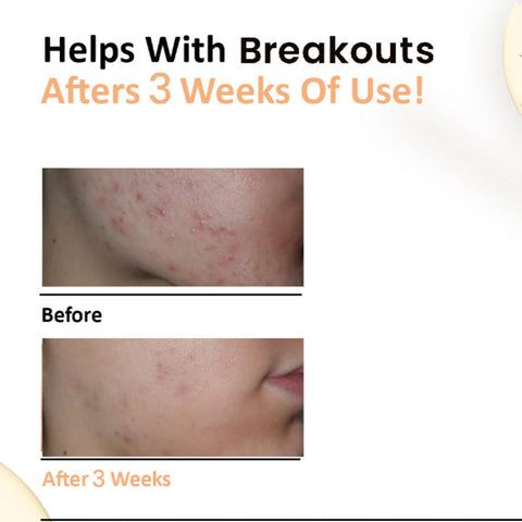 ANTI-ACNE SERUM -  Salicylic Acid 2% + Benzoyl Peroxide 5%